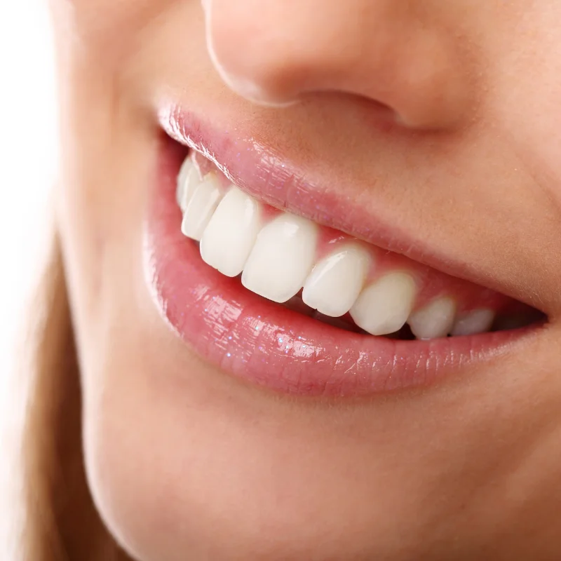 In-office teeth whitening at Fairmont Dental Centre in London