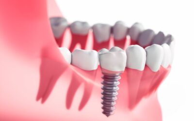 All You Need to Know About Dental Implants – Complete Guide