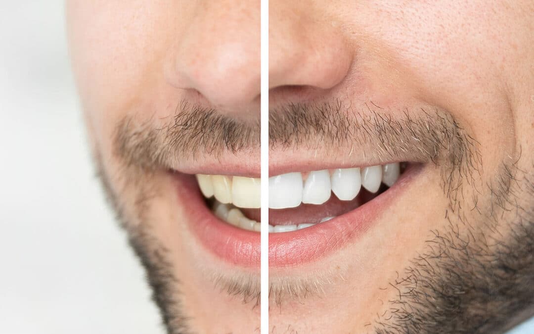 5 Reasons Why You Should Consider Teeth Whitening