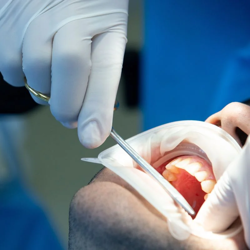 Dentist performing emergency dental treatment to relieve tooth pain at Fairmont Dental Centre in London Ontario