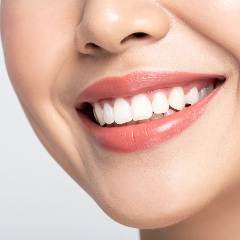 Close-up of healthy white smile during dental visit covered under CDCP at Fairmont Dental Centre in London Ontario